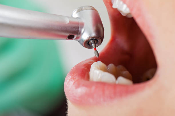Best Broken or Chipped Tooth Repair in Reliez Valley, CA